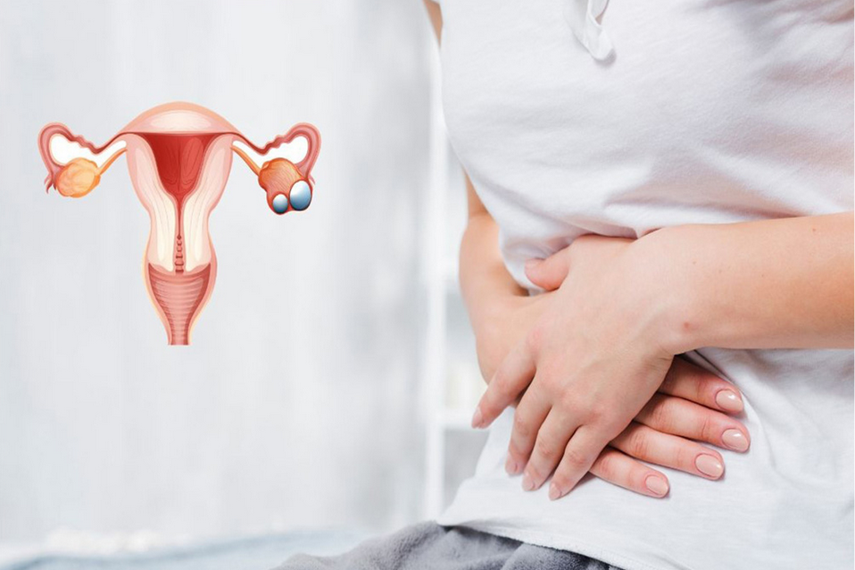 متلازمة تكيس المبايض