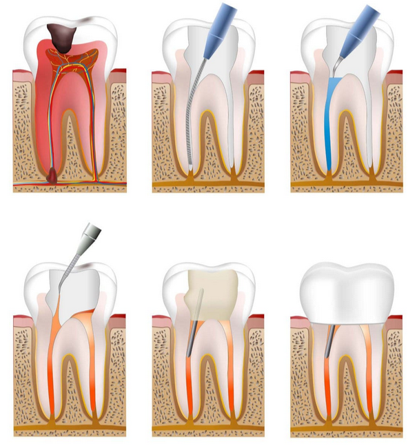 علاج الجذور