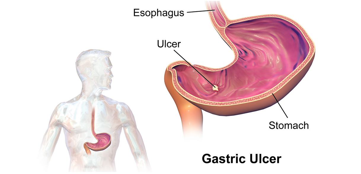 علاج قرحة المعدة