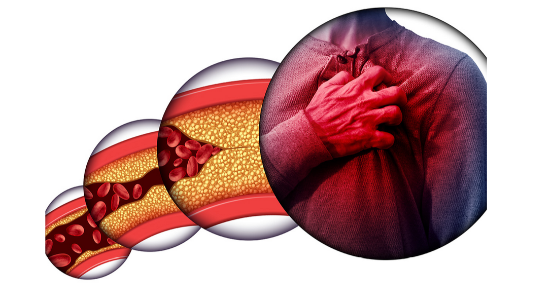 ارتفاع الكوليسترول