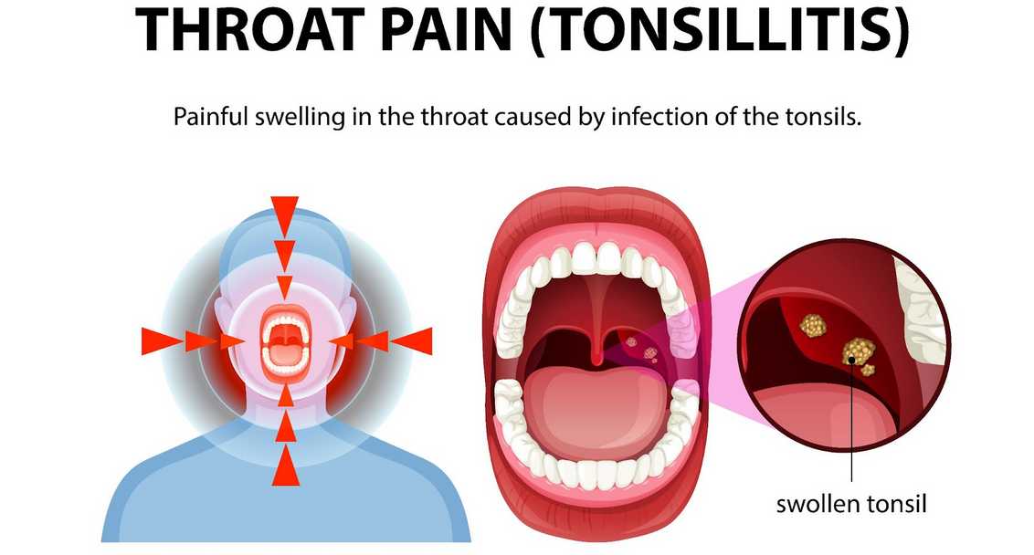 علاج التهاب اللوزتين