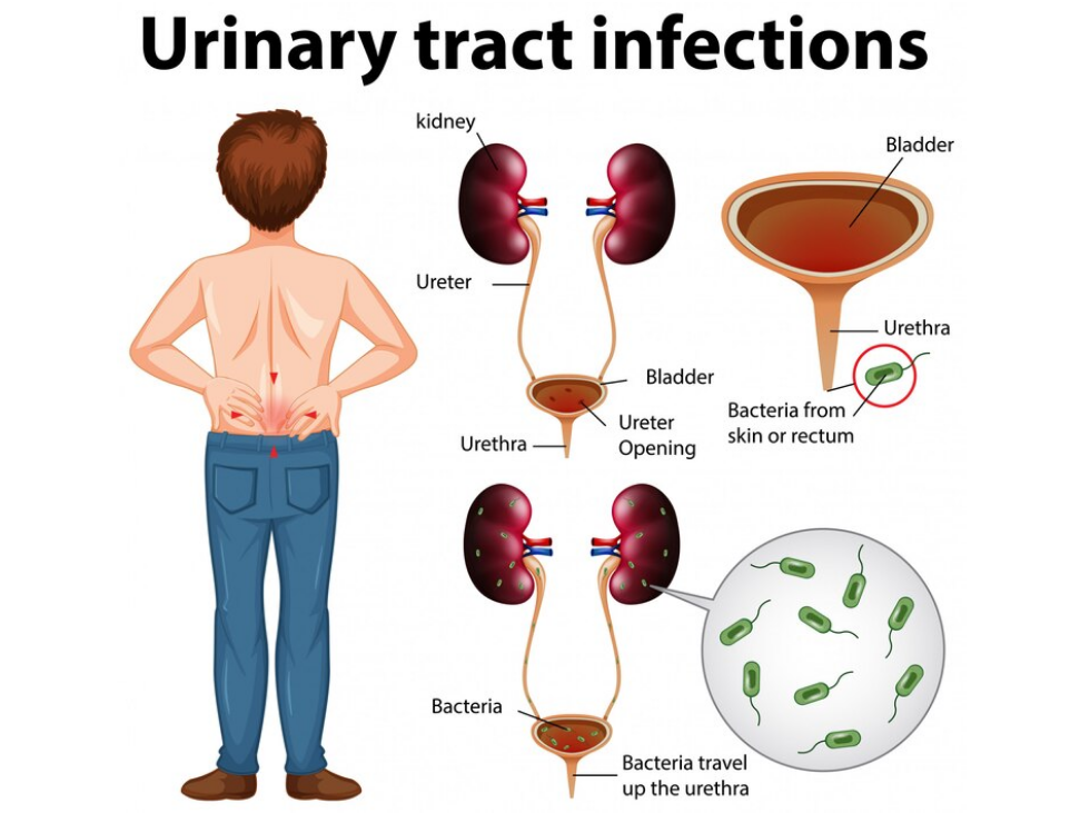 التهابات الجهاز البولي