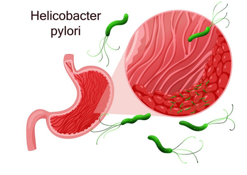 اعراض جرثومة المعدة