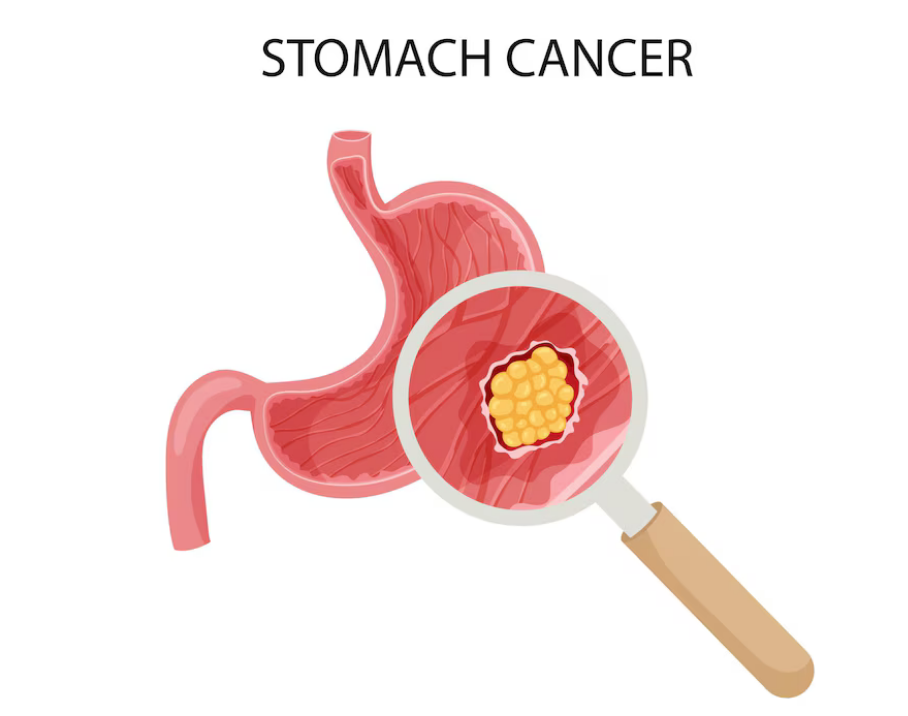 اعراض سرطان المعدة