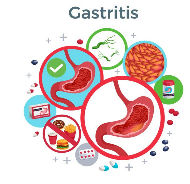 التهاب المعدة الشديد