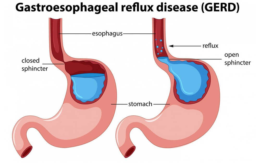 الارتجاع الحمضي (مرض الجزر المعدي المريئي)
