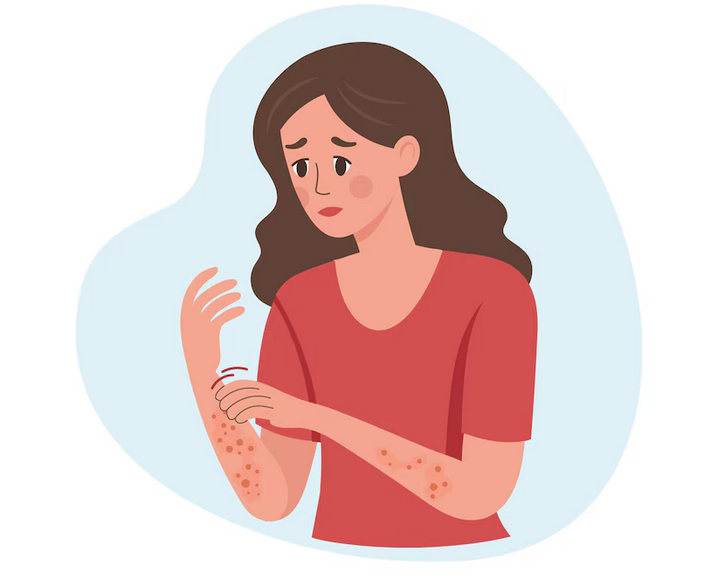 الإكزيما (التهاب الجلد التأتبي)