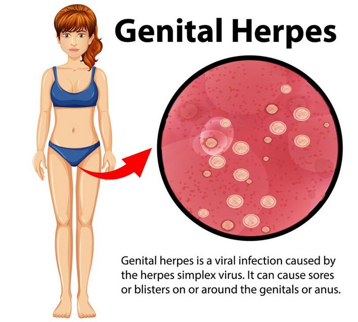 الهربس التناسلي