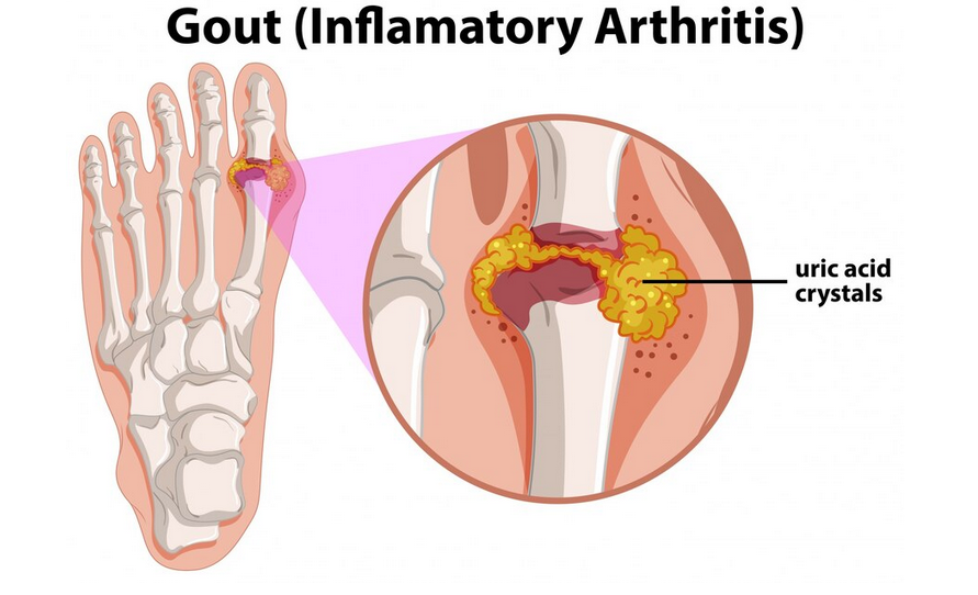 نوبة النقرس