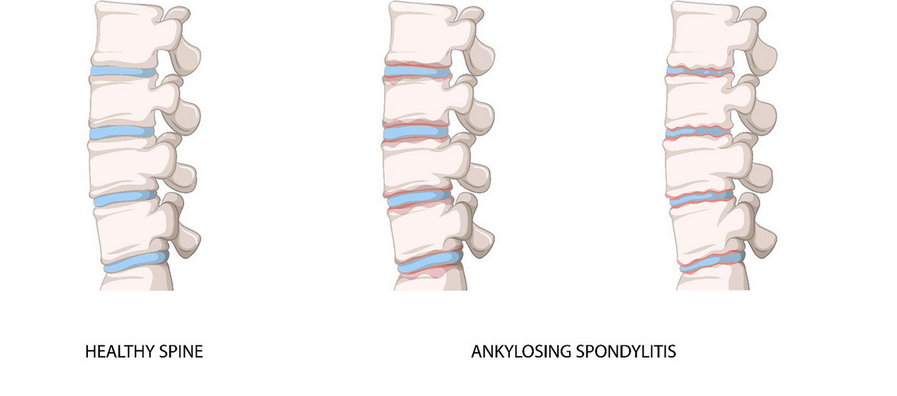 التهاب الفقرات التصلبي